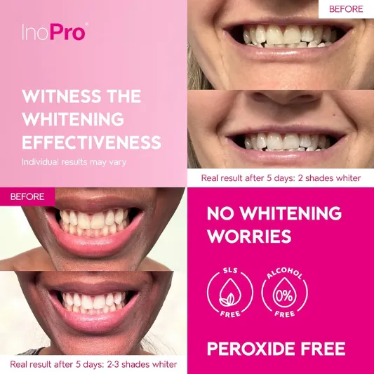 InoPro Teeth Whitening Strips Review 6 inopro teeth whitening strips review3
