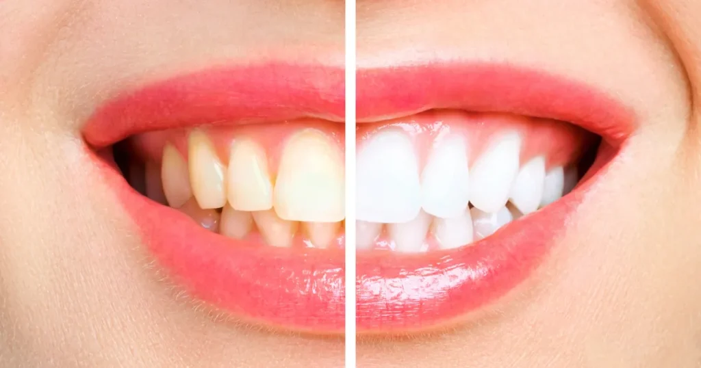 IvorySmile Teeth Whitening Strips Review