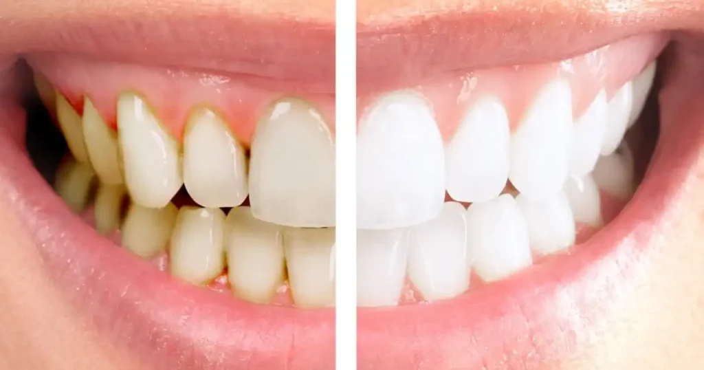 Whitening Strips vs Dentist Whitening (UK): Results, Cost & Safety